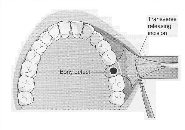 Diagram_of_Buccal_Advancement_Flap_used_to_close_an_OAC_2-615x433
