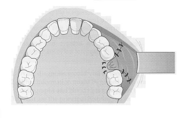 Diagram_of_Buccal_Advancement_Flap_used_to_close_an_OAC_3-615x403