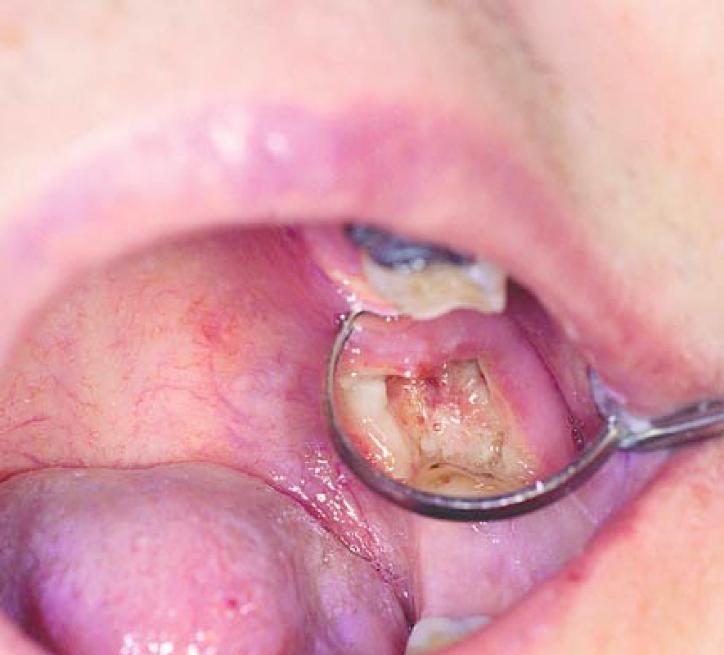 Photograph of Dry Socket