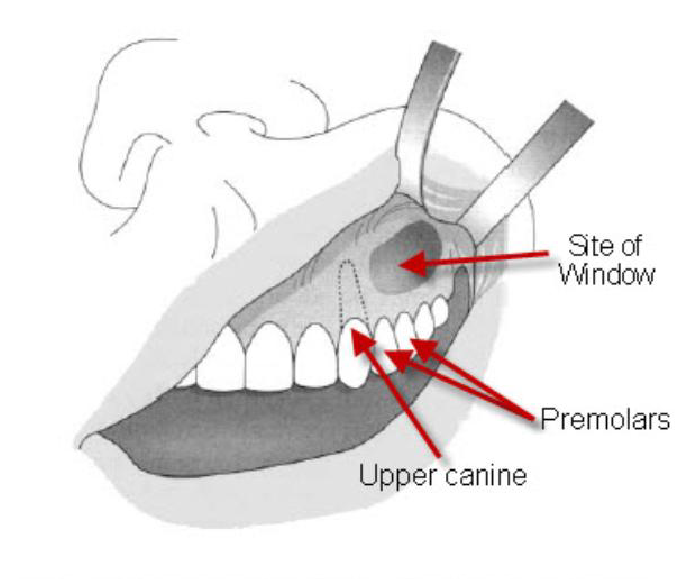 The Caldwell-Luc surgical procedure showing the site of the window into the anterior maxillary sinus.