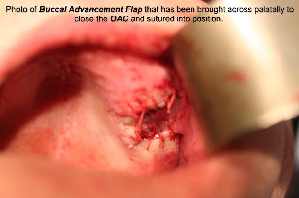 Photo_of_Buccal_Advancement_Flap_that_has_been_brought_across_palatally_to_close_the_OAC_and_sutured_into_position-615x408