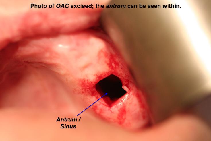 Photo_of_OAC_excised_-_the_antrum_can_be_seen_within-735x491