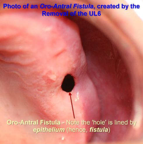 Photo_of_an_Oro-Antral_Fistula_created_by_the_Removal_of_the_UL6-490x496