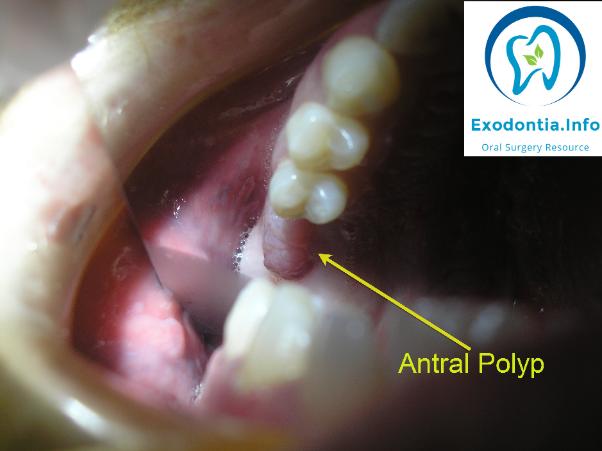 Photo_to_show_antral_polyp_herniating_through_socket_of_the_UL6-602x451