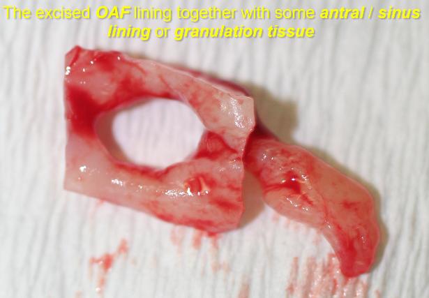 The_excised_OAF_lining_together_with_some_antral-sinus_lining_or_granulation_tissue-615x427