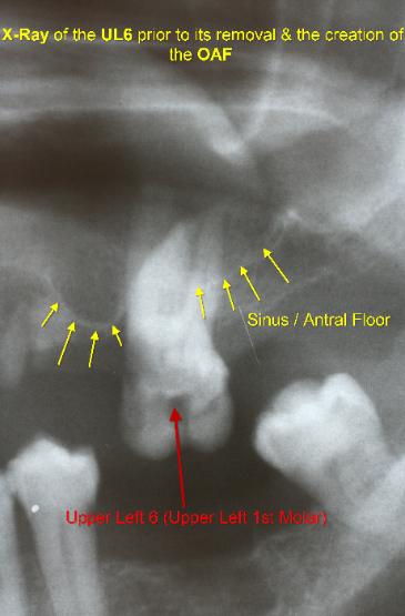 X-Ray_of_the_UL6_before_its_removal_the_creation_of_the_OAF-365x555