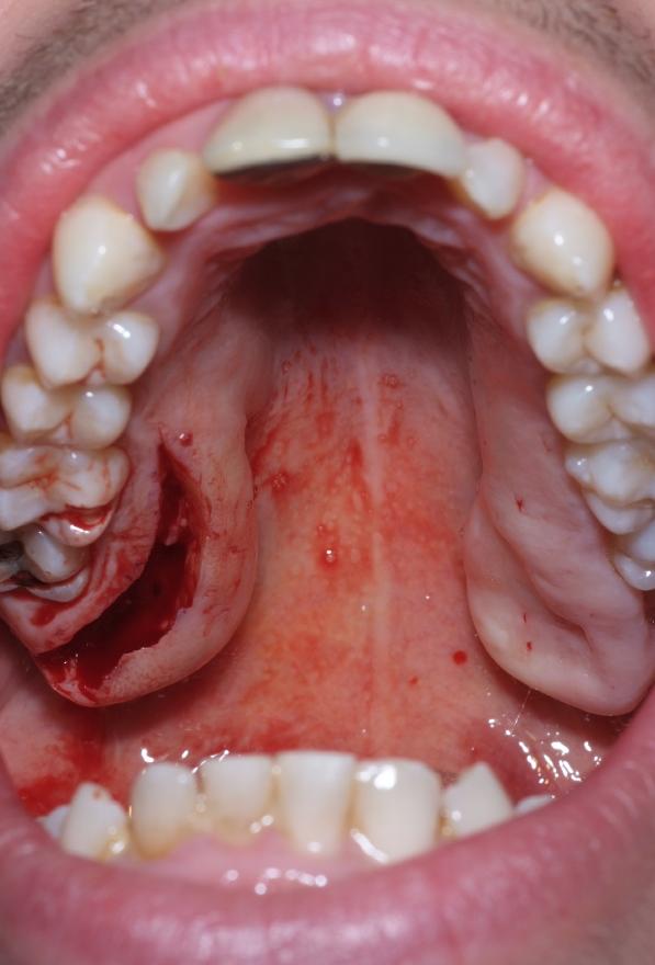 Resection of the Right Tuberosity