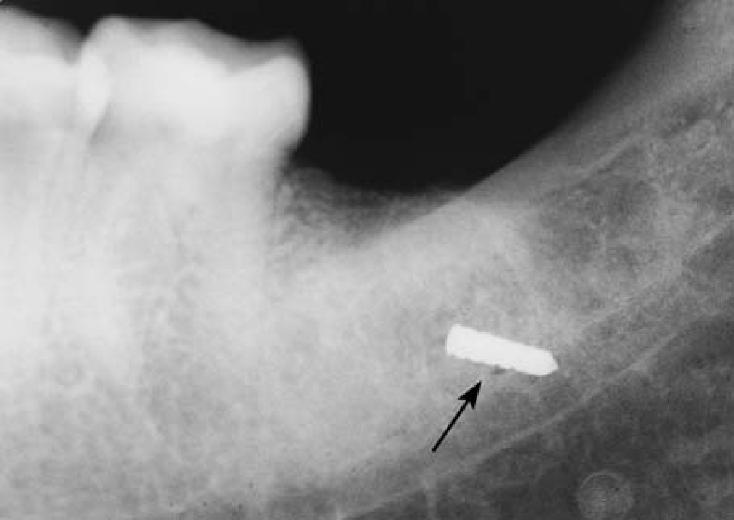 Broken fissure bur (arrowed) in tissues which occurred during the surgical removal of an impacted lower 3rd molar