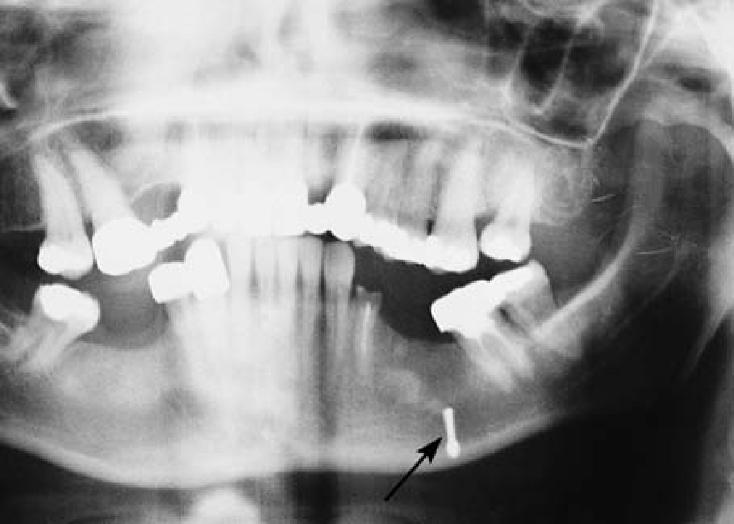 Broken round bur (surgical drill) and sub-periosteal dislocation of the bur which occurred during surgical extraction