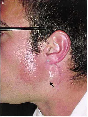 Frey_s_Syndrome_-_Gustatory_Sweating