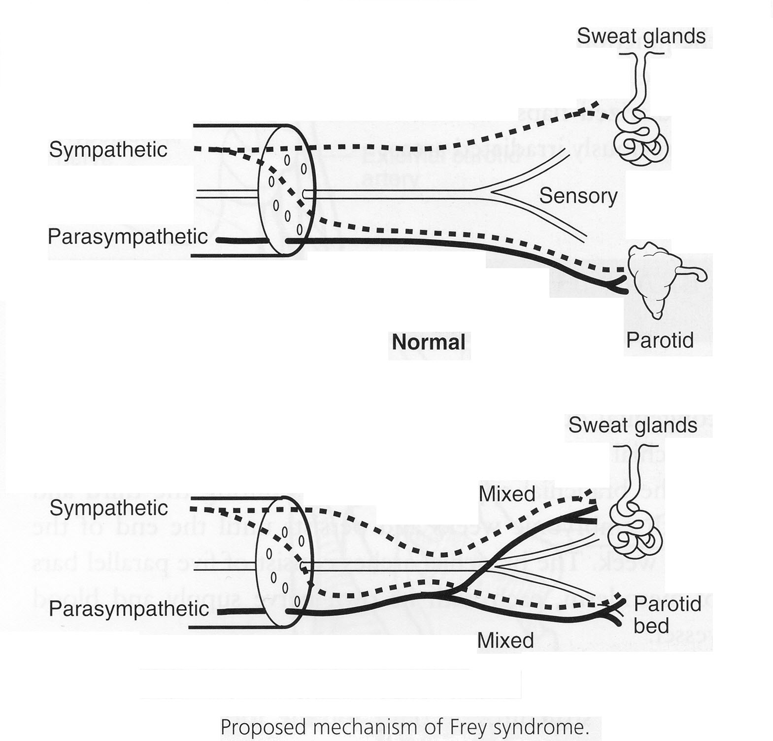 Proposed_Mechanism_of_Frey_s_Syndrome